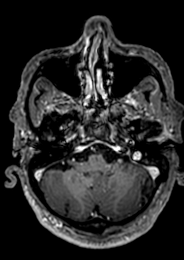 Accessory middle cerebral artery (Radiopaedia 73114-83828 Axial T1 C+ 143).jpg