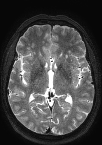 Accessory middle cerebral artery (Radiopaedia 73114-83828 Axial T2 74).jpg
