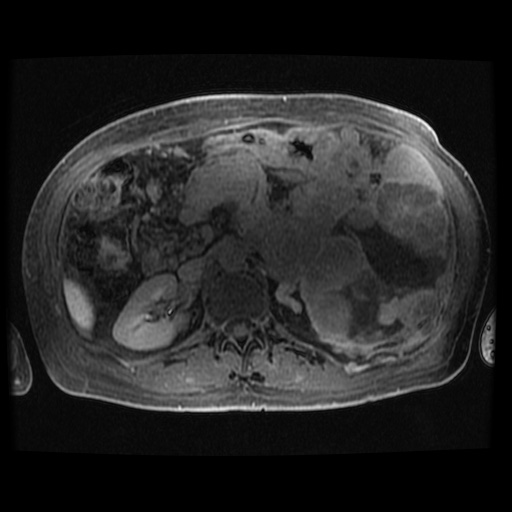 Acinar cell carcinoma of the pancreas (Radiopaedia 75442-86668 Axial late phase (~30 mins) 49).jpg