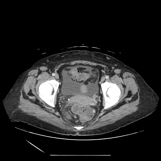Acinar cell carcinoma of the pancreas (Radiopaedia 75442-86669 Axial C+ portal venous phase 135).jpg