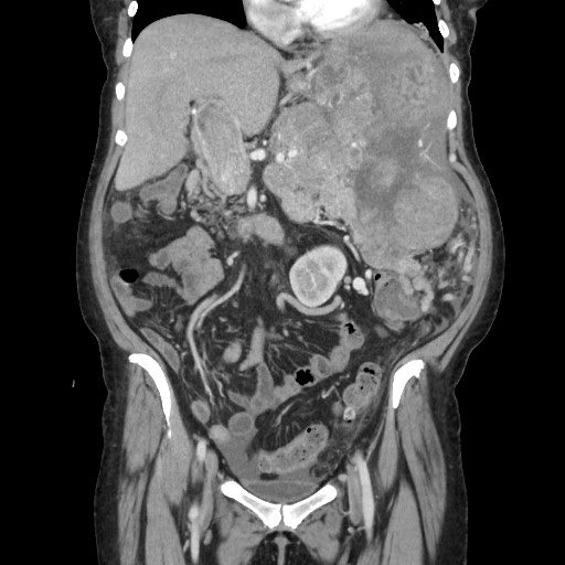 Acinar cell carcinoma of the pancreas (Radiopaedia 75442-86669 Coronal C+ portal venous phase 53).jpg