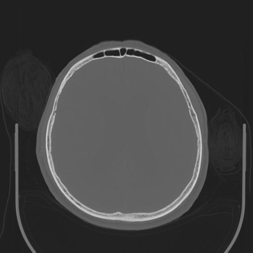 File:Acoustic schwannoma (Radiopaedia 29488-29982 AXIAL BONE THICK non-contrast 30).jpg