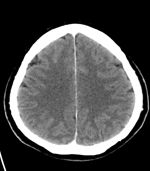 File:Acoustic schwannoma (Radiopaedia 33045-34065 Axial C+ delayed 20).png