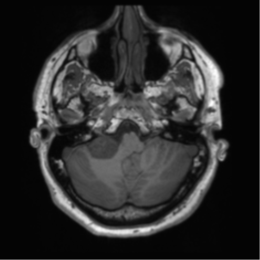 File:Acoustic schwannoma (Radiopaedia 50846-56358 Axial T1 13).png