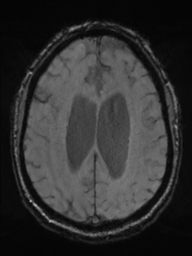 Acoustic schwannoma (Radiopaedia 55729-62281 Axial SWI 36).png