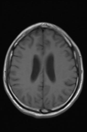 Acoustic schwannoma - probable (Radiopaedia 20386-20292 Axial T1 13).jpg
