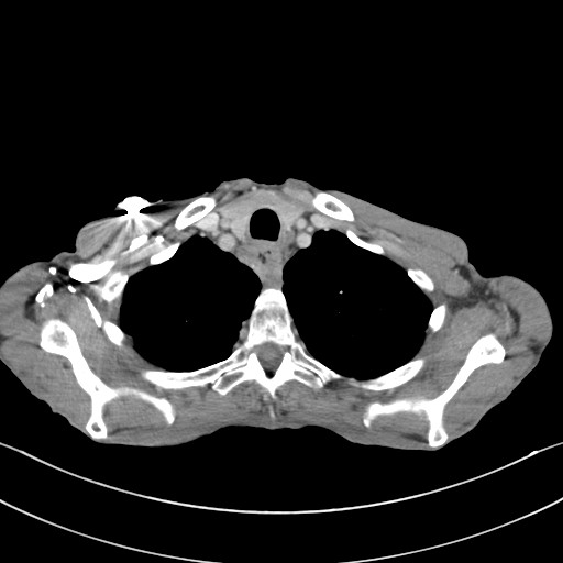 File:Acquired tracheoesophageal fistula (Radiopaedia 57747-65042 Axial C+ portal venous phase 13).jpg