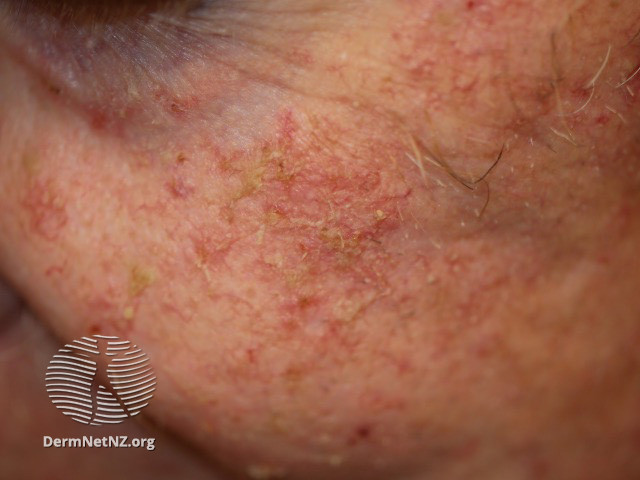 Actinic Keratoses affecting the face (DermNet NZ lesions-ak-face-440).jpg