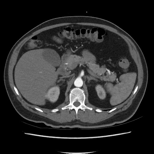 File:Active colonic bleed on CT (Radiopaedia 49765-55025 Axial C+ arterial phase 26).jpg