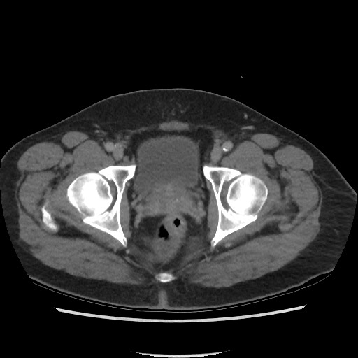 File:Active colonic bleed on CT (Radiopaedia 49765-55025 Axial C+ delayed 79).jpg
