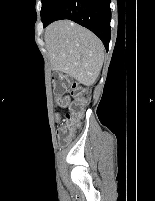 Active crohn disease (Radiopaedia 87133-103397 Sagittal C+ arterial phase 12).jpg
