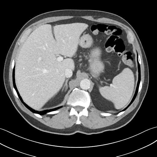 File:Active diverticular hemorrhage (Radiopaedia 39415-41725 Axial C+ portal venous phase 14).png