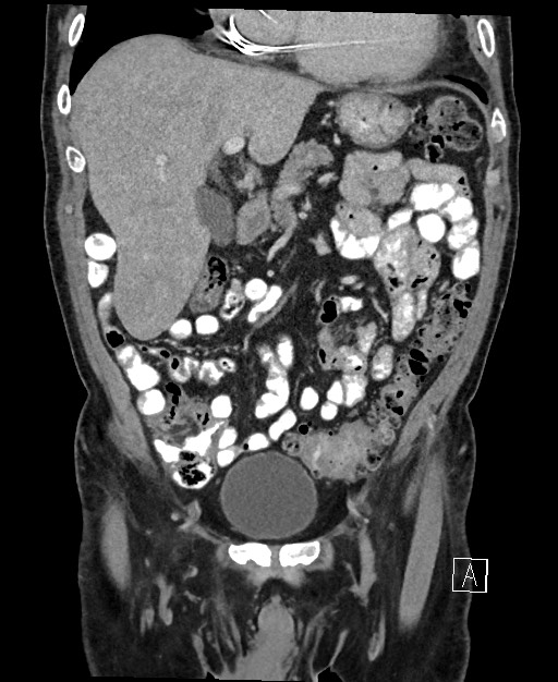 Active lower gastrointestinal bleeding - diverticular (Radiopaedia 61203-69106 Coronal C+ portal venous phase 49).jpg