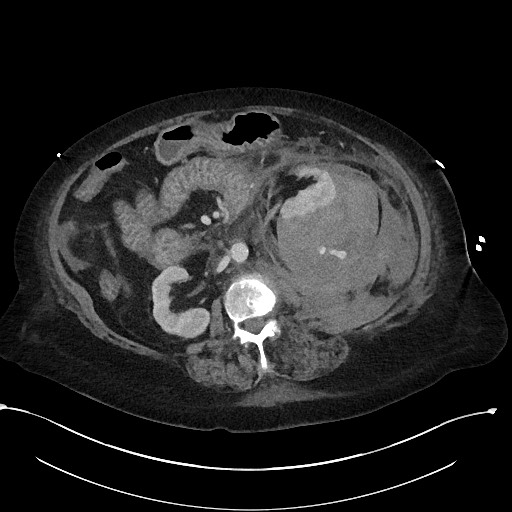 File:Active renal extravasation with large subcapsular and retroperitoneal hemorrhage (Radiopaedia 60975-68796 Axial 257).jpg