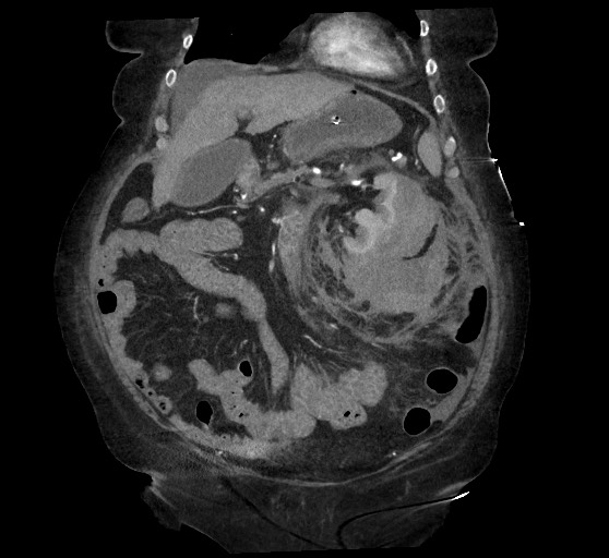 Active renal extravasation with large subcapsular and retroperitoneal hemorrhage (Radiopaedia 60975-68796 Coronal C+ arterial phase 53).jpg