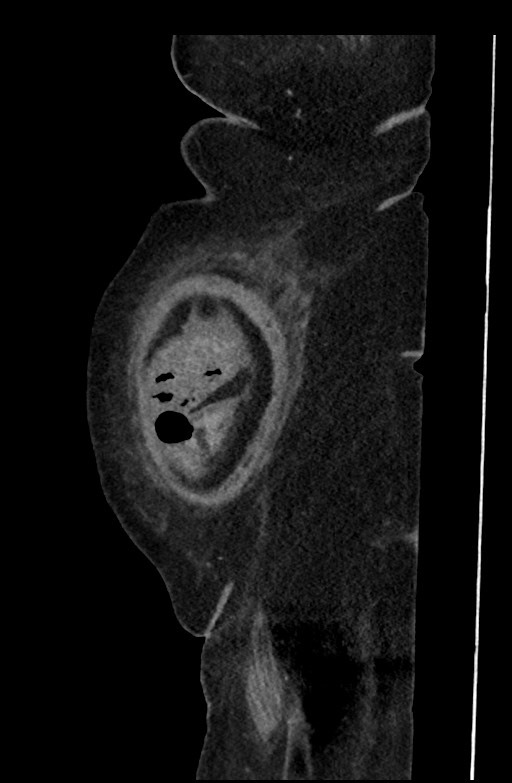Active renal extravasation with large subcapsular and retroperitoneal hemorrhage (Radiopaedia 60975-68796 Sagittal C+ portal venous phase 199).jpg