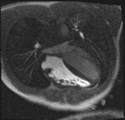 File:Active right ventricular cardiac sarcoidosis (Radiopaedia 55596-62100 Axial Dynamic perfusion scan MOCO 59).jpg