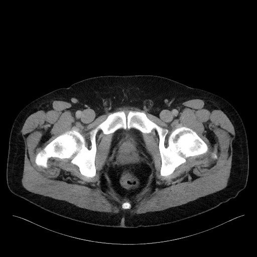 Acute-on-chronic pancreatitis (Radiopaedia 67286-76656 Axial C+ portal venous phase 82).jpg