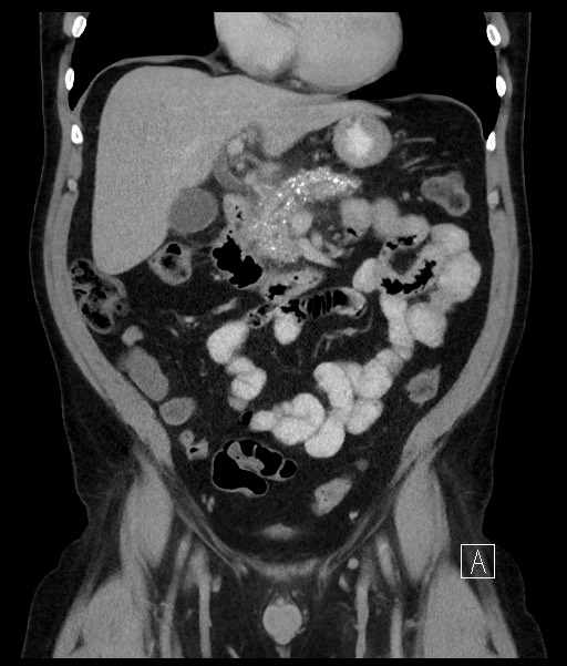 Acute-on-chronic pancreatitis (Radiopaedia 67286-76656 Coronal C+ portal venous phase 34).jpg