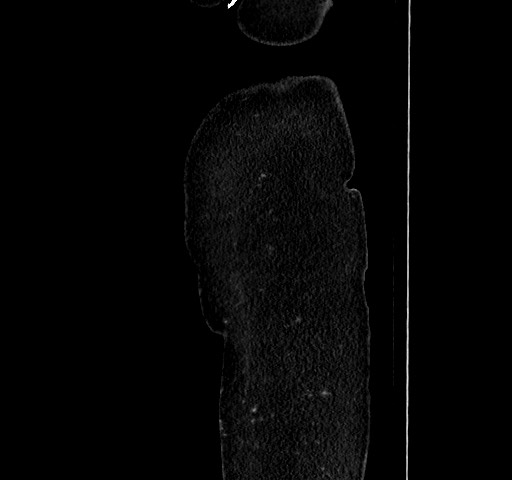 Acute appendicitis, heterotaxy syndrome (Radiopaedia 66884-76202 Sagittal C+ portal venous phase 10).jpg