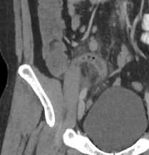 File:Acute appendicitis (Radiopaedia 10498-10973 Coronal C+ portal venous phase 1).jpg