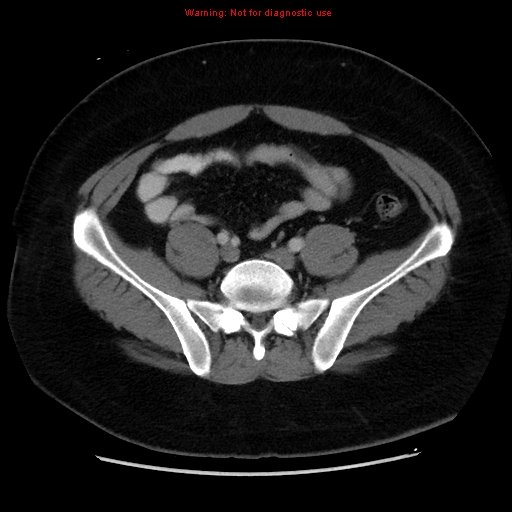 File:Acute appendicitis (Radiopaedia 12326-12607 Axial C+ portal venous phase 32).jpg