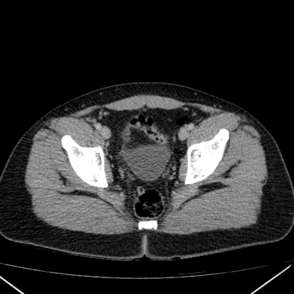 Acute appendicitis (Radiopaedia 38255-40270 Axial C+ portal venous phase 99).jpg