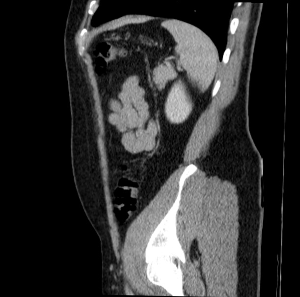 Acute appendicitis (Radiopaedia 38255-40270 Sagittal C+ portal venous phase 65).jpg