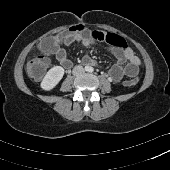 Acute appendicitis (Radiopaedia 48792-53822 Axial C+ portal venous phase 65).jpg