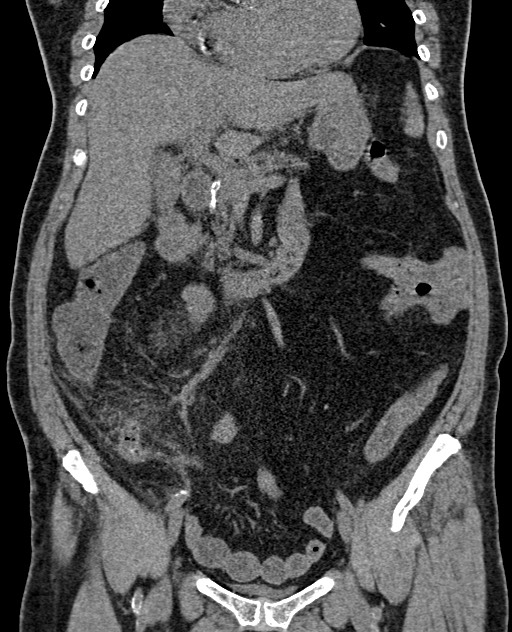 Acute appendicitis (Radiopaedia 58627-65818 Coronal non-contrast 36).jpg
