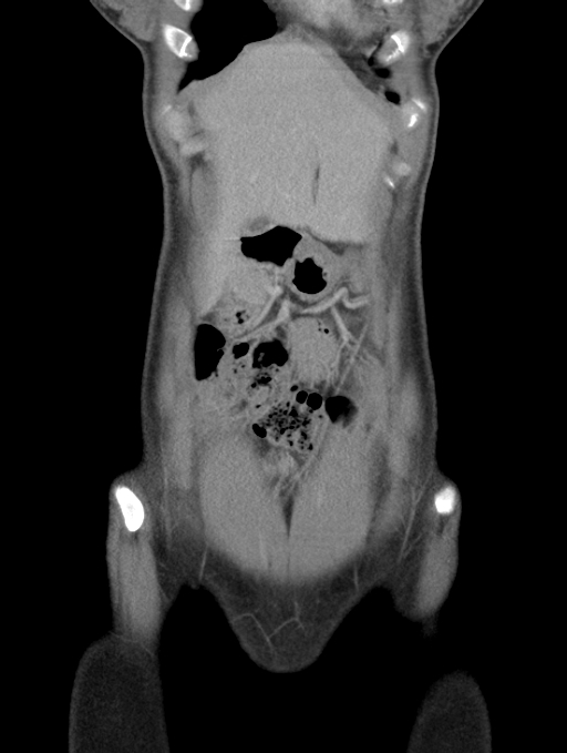 Acute appendicitis (Radiopaedia 62608-70901 Coronal C+ portal venous phase 4).jpg