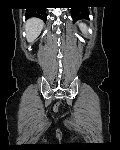 Acute appendicitis - large appendicoliths (Radiopaedia 61805-69820 Coronal C+ portal venous phase 114).jpg