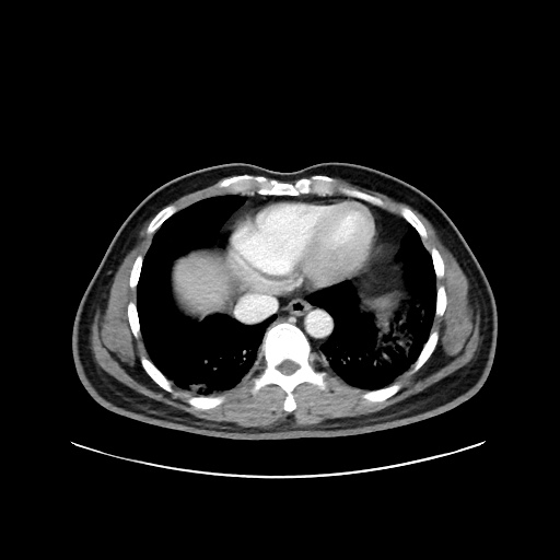 Acute appendicitis and COVID 19 pneumonia (Radiopaedia 76604-88380 Axial C+ portal venous phase 4).jpg
