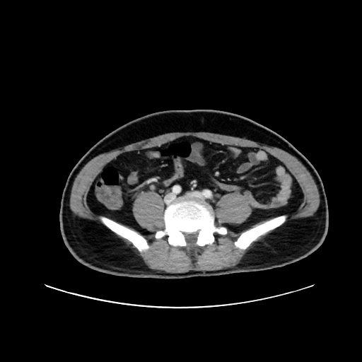 Acute appendicitis and COVID 19 pneumonia (Radiopaedia 76604-88380 Axial C+ portal venous phase 54).jpg