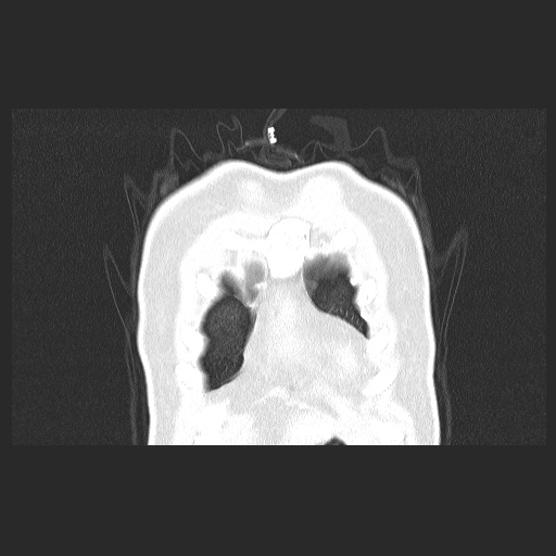 Acute appendicitis and COVID 19 pneumonia (Radiopaedia 76604-88380 G 9).jpg