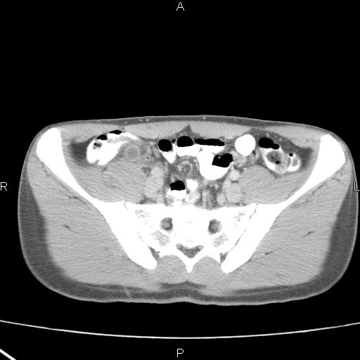 File:Acute appendicitis with CT arrowhead sign (Radiopaedia 21474-21411 Axial C+ portal venous phase 30).jpg