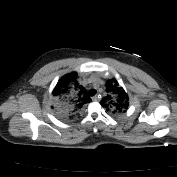 Acute aspiration pneumonitis (Radiopaedia 33605-34703 Axial non-contrast 27).jpg