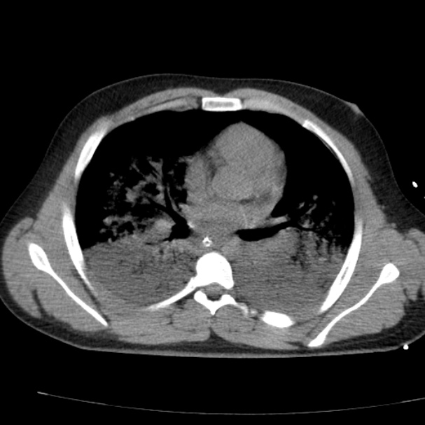 Acute aspiration pneumonitis (Radiopaedia 33605-34703 Axial non-contrast 47).jpg