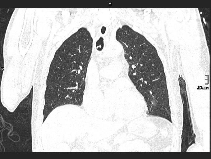 File:Acute aspiration pneumonitis (Radiopaedia 55642-62166 Coronal lung window 42).jpg