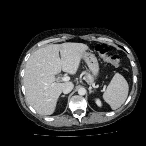 File:Acute cholecystitis and incidental left sided IVC (Radiopaedia 49352-54459 Axial C+ portal venous phase 45).jpg