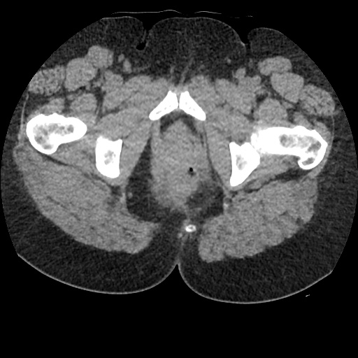 File:Acute cholecystitis and ureteric colic (Radiopaedia 42330-45444 Axial prone 113).jpg