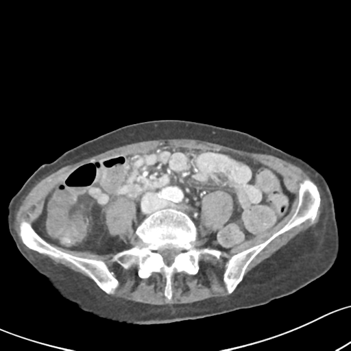 Acute cholecystitis with contained perforation (Radiopaedia 47328-51907 Axial C+ portal venous phase 45).png
