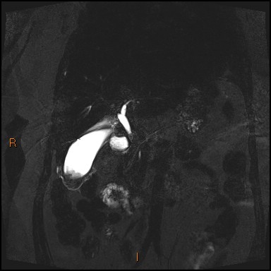 File:Acute cholecystitis with gallbladder neck calculus (Radiopaedia 42795-45971 Coronal Turbo spin echo 27).jpg