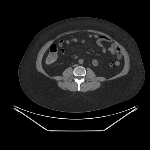 Acute cholecystitis with tensile fundus sign (Radiopaedia 71394-81723 Axial non-contrast 56).jpg