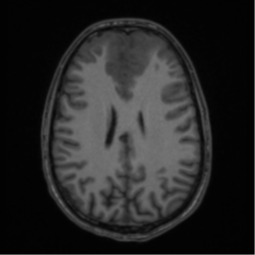 Acute disseminated encephalomyelitis (ADEM) (Radiopaedia 65319-74349 Axial T1 43).png