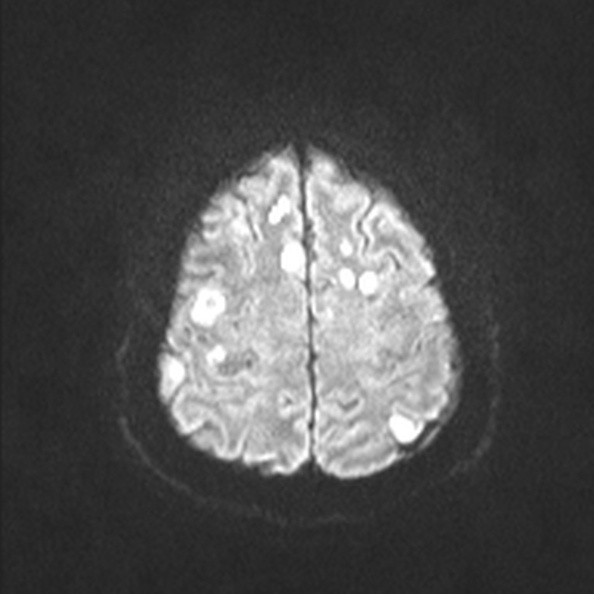 Acute disseminated encephalomyelitis (Radiopaedia 37253-39033 Axial DWI 49).jpg