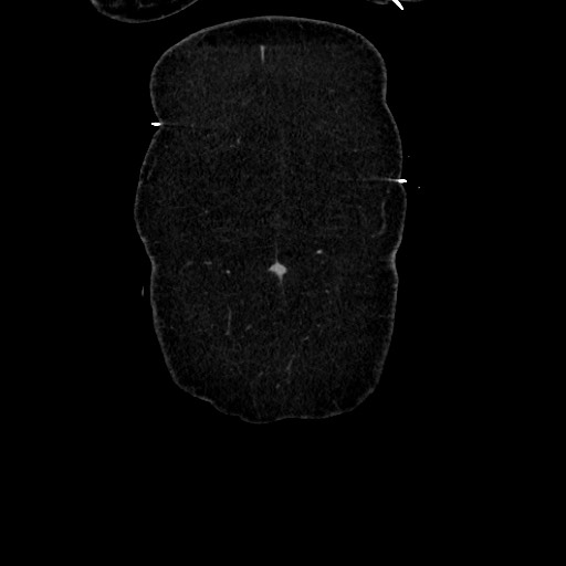 Acute diverticulitis - transverse colon (Radiopaedia 87063-103327 Coronal C+ portal venous phase 24).jpg