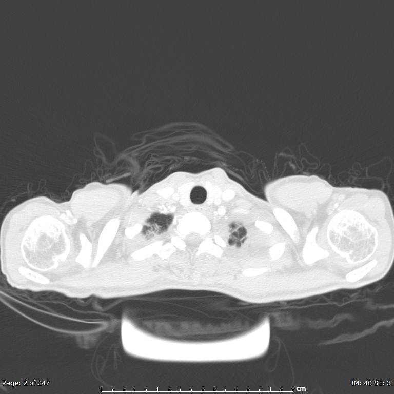 Acute eosinophilic pneumonia (Radiopaedia 48211-53073 Axial lung window 1).jpg