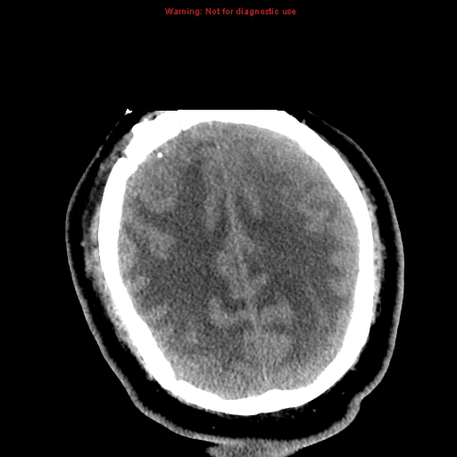 File:Acute hemorrhagic leukoencephalitis (Radiopaedia 14076-72275 Axial non-contrast 32).jpg