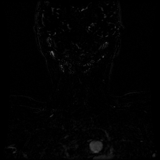 Acute internal carotid artery dissection (Radiopaedia 53541-59632 Coronal MRA 6).jpg